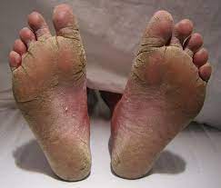 Wearing Shoes Without Wearing Socks Contains More Dangerous Consequences Than You Think