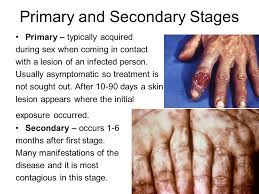 We did not find results for: Syphilis Treponema Pallidum What Is Syphilis A Sexually Transmitted Disease Living In The Genital Tract And Can Be Fatal If Left Untreated A Spirochete Ppt Download