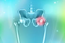 Perturbarea echilibrului articular in coxartroza poate fi determinata de factori biologici sau mecanici. Tratamentul Pentru Coxartroza Ce Trebuie Sa Stii