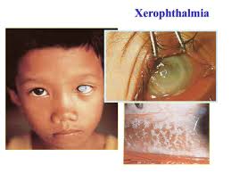 Golden Rice & Golden Crops Peter Beyer University of Freiburg Germany  Transgenic Plants for Food Security in the Context of Development  Pontifical Academy.