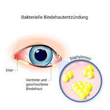 Augenentzundungen Wichtige Erkrankungen Im Uberblick Aumedo