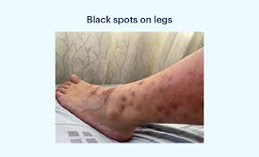 Image result for liver spots on legs