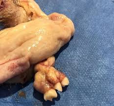 Dermoid ovarian cyst with hair and teeth. A Rare Image Of A Mature Cystic Teratoma Of The Ovary Exhibiting Multiple Tissue Types Containing Epidermis Hair And Teeth Medizzy