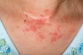 Image result for dermatitis contacta allergica