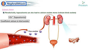 Image result for Calcium Nephrolithiasis
