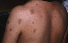 Vucutta Kahverengi Lekeler Neyin Belirtisi Bilgio Net