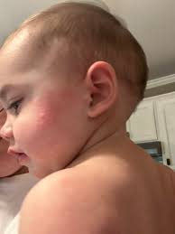 Anyone one heard of a baby being "hivey"? And no it's not a rash.