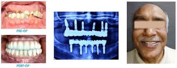 Dental implants treatment and cost in India