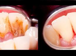 Designed to deep clean gums. 4 Mixtures That Completely Remove Plaque From Your Teeth
