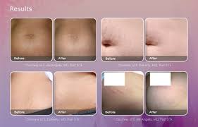 Check spelling or type a new query. Icon 1540 Fractional Non Ablative Contemporary Health Center