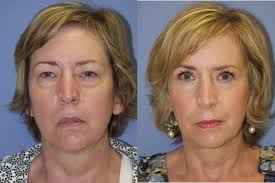 Eyelid Surgery Columbus GA