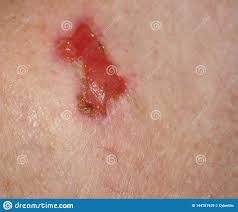 Orientation diagnostic pour un traitement selon la cause, pruritus of the skin: Cancer De La Peau Sur Un Corps Humain Image Stock Image Du Corps Humain 144781939