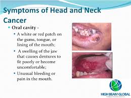 What are 18 signs and symptoms of cancer? Head And Neck Cancer