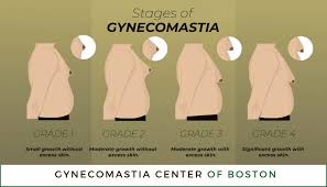 Image result for Gynecomastia