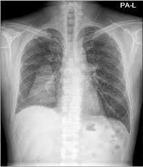 Most effusions start like this and can be easily missed. Chest Radiograph Showing Right Loculated Pleural Effusion Download Scientific Diagram