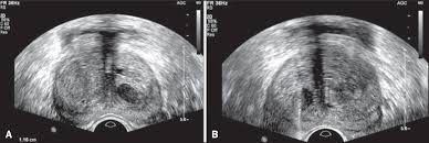 There are no incisions or even any needles used. Scielo Brasil The Role Of Transrectal Ultrasound In The Diagnosis Of Prostate Cancer New Contributions The Role Of Transrectal Ultrasound In The Diagnosis Of Prostate Cancer New Contributions