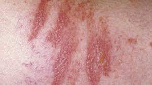Contact with skin causes ficin dermatitis in people who are sensitive. Phytophotodermatitis Symptoms Causes And More