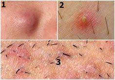 Common areas for ingrown hairs. 9 Ingrown Hair Ideas Ingrown Hair Ingrown Hair Remedies Ingrown Hair Removal