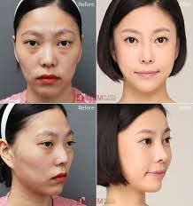Pin On Lip Lift