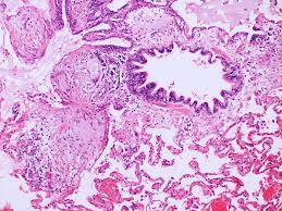 We did not find results for: Pathology Outlines Uip Ipf