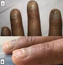 Image result for Beau lines feet