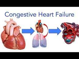 Want To Know About Managing Congestive Heart Failure Chf At Home Here Are Some Information That In 2021 Congestive Heart Failure Heart Failure What Is Heart Failure