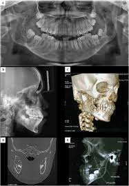 Histopathology reveals multinucleated giant cells in the. Orthodontic Treatment In A Patient With Cherubism Benefits And Limitations Miranda Galvis 2020 Special Care In Dentistry Wiley Online Library