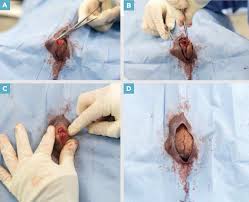 睾丸切除术的最新进展- 知乎