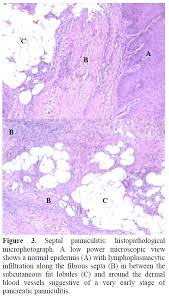 Image result for Panniculitis