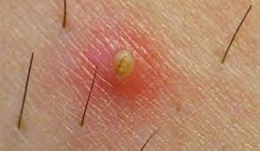 Ingrown hairs cause red, often itchy bumps where a hair has grown back into the skin. Deep Ingrown Hair How To Remove On Neck Bikini Face Leg Causes Home Remedies