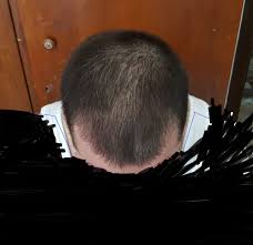 Cinsellik Ve Sac Dokulmesi Sayfa 8