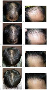 View before and after photos of select patients with positive results using propecia and/or rogaine. Long Term 10 Year Efficacy Of Finasteride In 523 Japanese Men With Androgenetic Alopecia