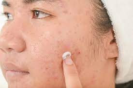 Here is how you can remove blemishes (while treating acne) with wonderful secrets from my grandmother's diary. How To Get Rid Of Acne Scars Using Baking Soda How To Treat Your Skin With The Household Ingredient
