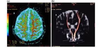 Nelis, tiene 55 años de edad, su familia inmediata incluye a su esposo josé saul, sus hijas jenny y lesley, y sus 6 nietos. Mr Diffusion Tensor Imaging Dti A Fractional Anisotropy Parametric Download Scientific Diagram