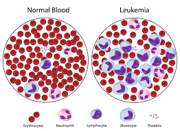 The cancerous cells which grow in numbers, do not function like they normally should. Leukaemia Causes Symptoms And Treatment Demoadefa S Blog
