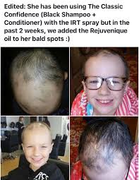 Not as severe as ours. The Most Extreme Kind Of Alopecia No Hair At All To Where She Is At Today I Continue To Take Photos Every Few Days So Peopl Irt Spray Monat Is Black