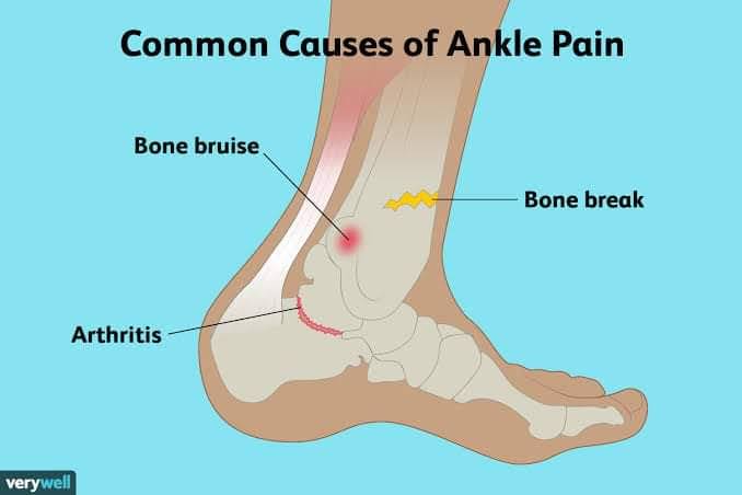 Ankle Pain product image