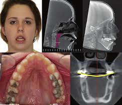 The Transverse Dimension: Diagnosis and Relevance to Functional Occlusion  Roth Williams Legacy Fund Donors