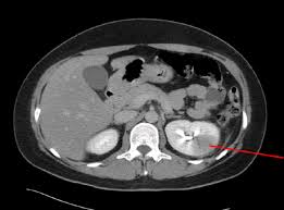 이 ct coronal image에서 충수돌기의 기저부(base)부터 원위부까지 두꺼워진 벽과 커진 직경을 관찰 할 수 있습니다. Clinical Differences In Acute Kidney Injury Between Unilateral Acute Pyelonephritis And Bilateral Acute Pyelonephritis