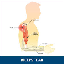 The shoulder joint (glenohumeral joint) is a ball and socket joint between the scapula and the humerus. Bicep Tenodesis Information Florida Orthopaedic Institute