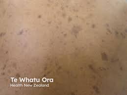 Image result for Postinflammatory Hyperpigmentation