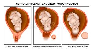 Cervical Effacement Stock Illustrations 8 Cervical