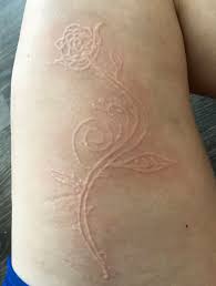 Image result for Dermatographism