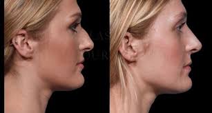 How much does it cost to get a nose job. The Modern Nose Job Liquid Rhinoplasty Vs Surgical Rhinoplasty