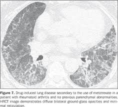 Intrathoracic Manifestations Of Collagen Vascular Diseases On High Resolution Chest Computed Tomography
