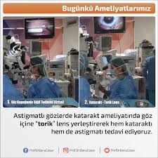 Astigmatli Gozlerde Katarakt Ameliyatinda Goz Icine Torik Lens Yerlestirerek Hem Katarakti Hem De Astigmati Tedavi Ediyoruz Katarakt Cata Bilgi Ordu Ikiz