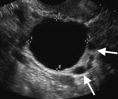 Ovarian cancer is the deadliest gynaecological cancer and the uk has one of the lowest survival rates in western europe. Adnexal Masses Us Characterization And Reporting Radiology