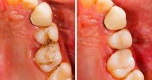 Over time, the enamel is weakened and destroyed, forming a cavity. How To Heal Tooth Cavities Yourself And Relieve Pain Quickly At Home Know Here