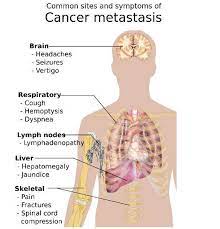 It can spread to distant organs, such as the lungs. Zometa For Preventing Bone Cancer Complications Clinical Trials Arena