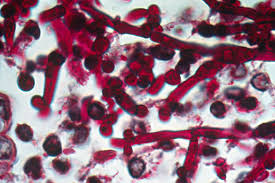 Image result for Candidiasis